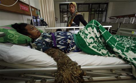 Tree Man Dede Koswara Who Suffers From Rare Condition Dies In Indonesia