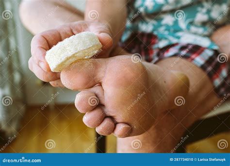 Man Taking Care Dry Cracked Skin Legs Stock Photo Image Of Eczema