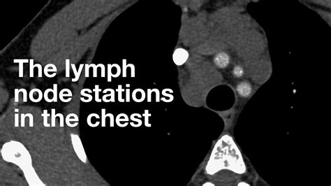 The Lymph Node Stations In The Chest Youtube
