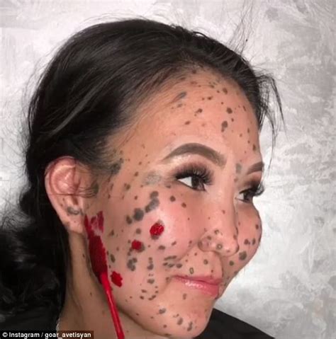 Woman Born With Moles On Her Face Reveals Transformation Daily Mail