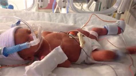 28 Week Preemie Sophias One Year Journey Youtube