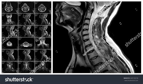 710 Mri Cervical Spine Images Stock Photos Vectors Shutterstock
