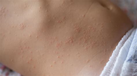 Whats That Rash With Pictures Queensland Health
