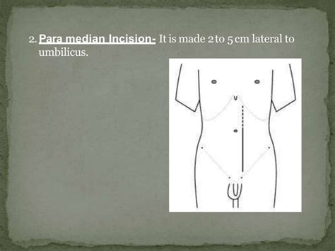 Abdominal Incisions