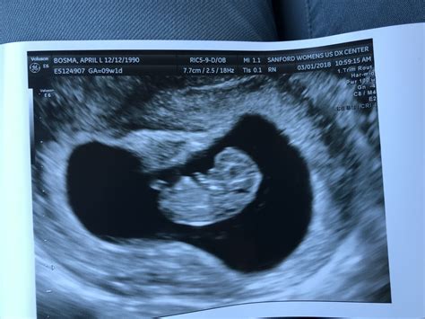 Your 7 Week Ultrasound October 2018 Babies Forums What To Expect