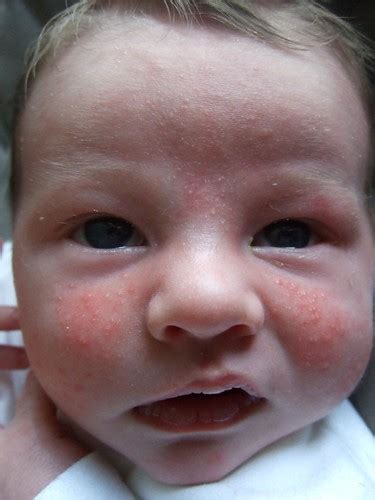 Milk Rash Spots With Red And White Headed Spots Wedding Planning