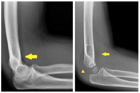 How To Approach The Pediatric Elbow Emra