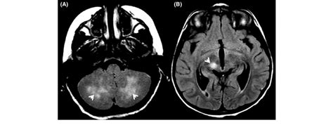 A Cerebellar Lesions With Moderate Cerebral Edema B High Intensity