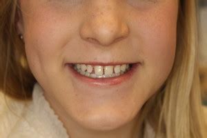 The gap could also be caused by a small piece of gum/flesh between the teeth called a frenum. Gaps between teeth? We have solutions! - Southpointe ...