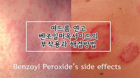 Adverse effects have become evident. 벤조일퍼옥사이드 여드름연고의 부작용과 해결방법 : benzoyl peroxide's side ...