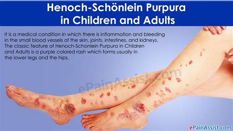 Henoch Schonlein Purpura HSP الأسباب والأعراض والعلاج الجلد مشاكل وعلاج