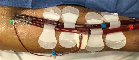 Cannula Position And Dressings Alfred ECMO Guideline