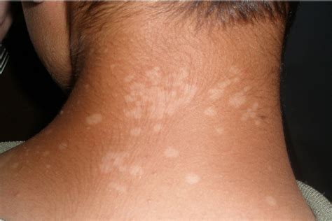 Large White Spots On Skin