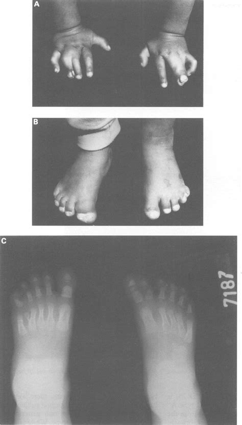 A C Hands And Feet Of Subject 73 In Spd 1 Manifesting Preaxial