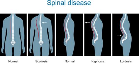 Diseases Of The Spine Scoliosis Lordosis Kyphosis Bod