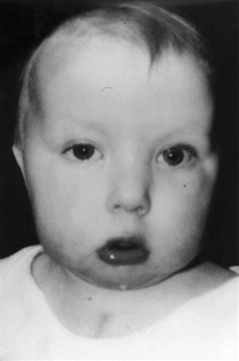 Digeorge Syndrome Velocardiofacial Syndrome
