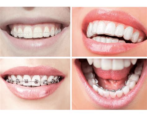 Todo Lo Que Necesitas Saber Sobre Brackets Clínica Dental Dra