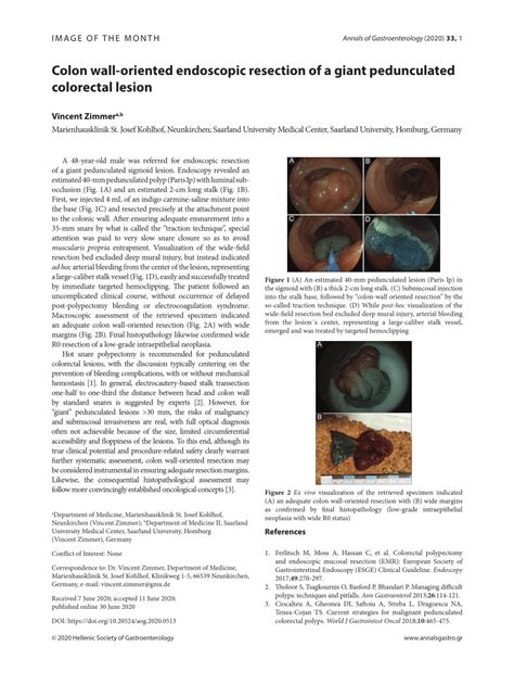 PDF Colon Wall Oriented Endoscopic Resection Of Giant Pedunculated