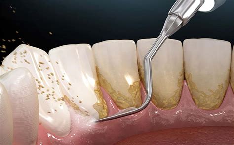 Tooth Scaling And Root Planing Elevate Dental