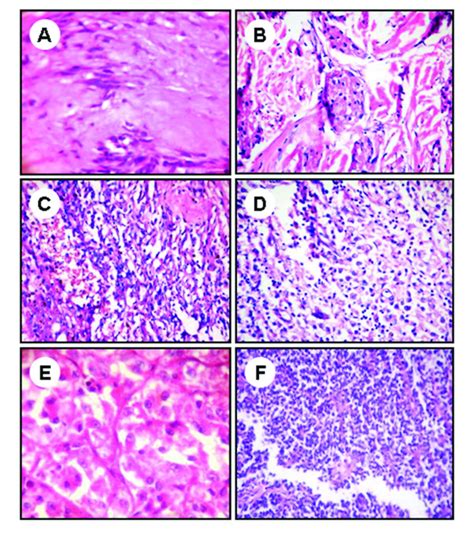 Pathologic Features Of Benign Intermediate And Malignant Soft Tissue