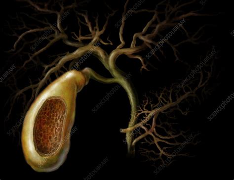 Gallbladder Stock Image P5300161 Science Photo Library