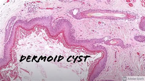 Dermoid Cyst 5 Minute Pathology Pearls Youtube