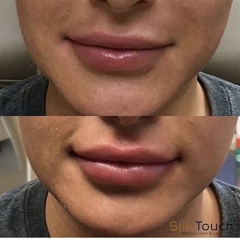 lip filler before and after pictures boise idaho