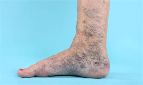 Do You Suffer With Varicose Veins In These Intimate Places Uk