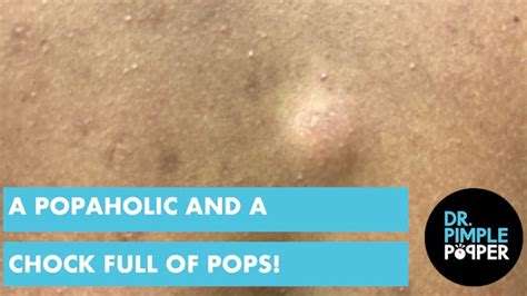 Steatocystoma Station Dr Pimple Popper