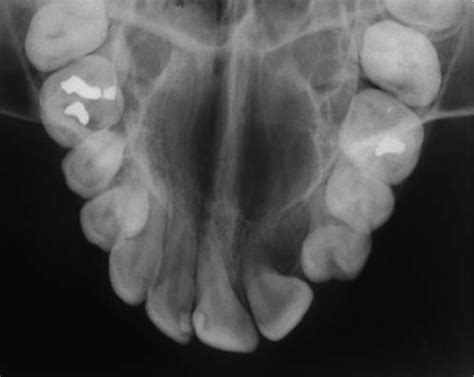 Unusual Intraosseous Transmigration Of Impacted Tooth