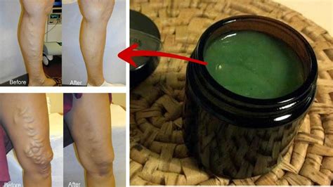 Get Rid Of Varicose Veins With This Simple Recipe Youtube