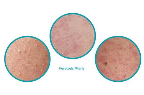 Keratosis Pilaris Explained What It Is And How To Treat It Ameliorate