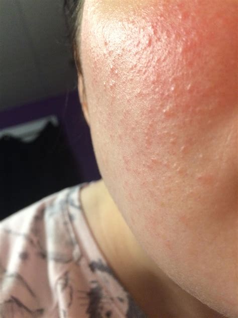 Skin Concerns Bumpy Texture That Wont Go Away Skincareaddiction