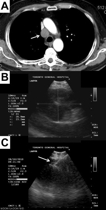 Endobronchial Ultrasound Guided Transbronchial Needle Aspiration In The