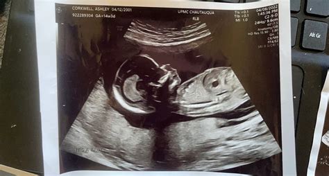 14 Week Ultrasound Boy Or Girl Based Of Skull Theory Babycenter