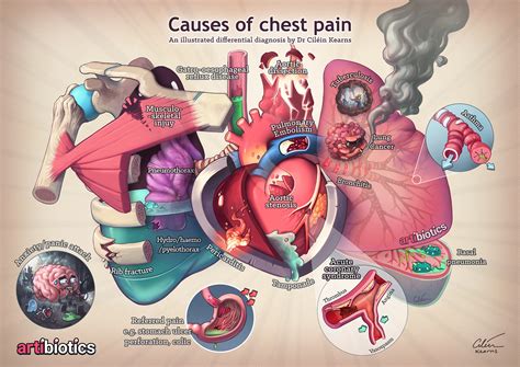 Causes of chest pain — artibiotics