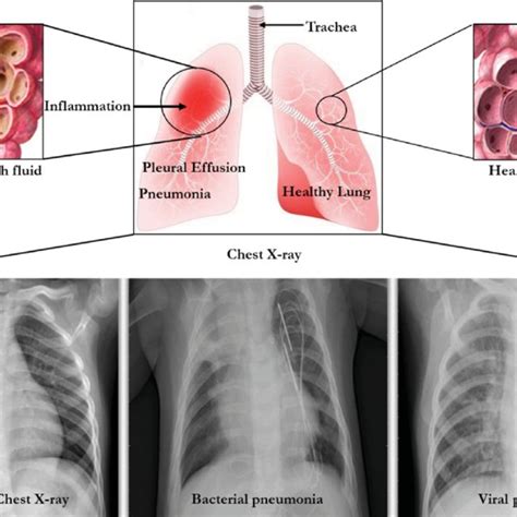 The Lungs And Chest X Rays Showing Inflammation Leading To Pneumonia