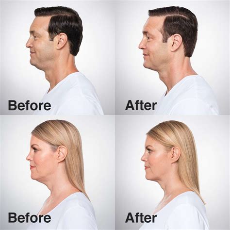 Kybella® For Treatment Of Double Chins Salmon Creek Plastic Surgery