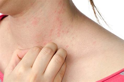 Hives Allergy And Asthma Network