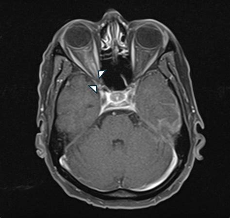 Cureus Optic Nerve Infiltration In Systemic Lymphoma In An Hiv Patient