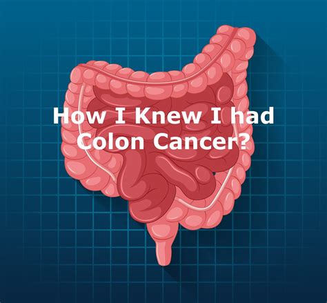 How I Knew I Had Colon Cancer Survival Rate Stages And Treatment