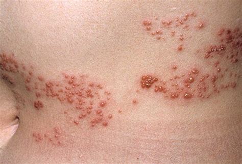 The appearance of viral rashes depends on the kind of measles is a common viral rash caused by a respiratory virus. Rosacea, Acne, Shingles, Covid-19 Rashes: Common Adult ...