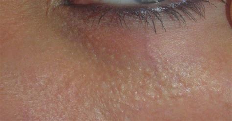 White Bumps Under The Eyes Called Milia And How To Get Rid Of Them