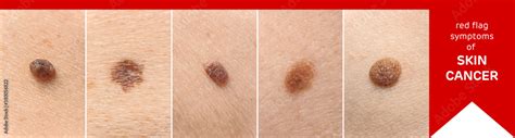 Different Types Of Moles On Human Skin Closeup Concept Of Skin Cancer