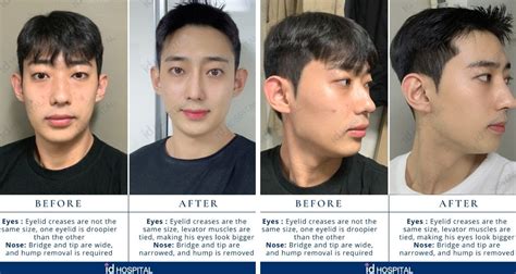 Plastic Surgery In South Korea In 2022 Clinics On Call