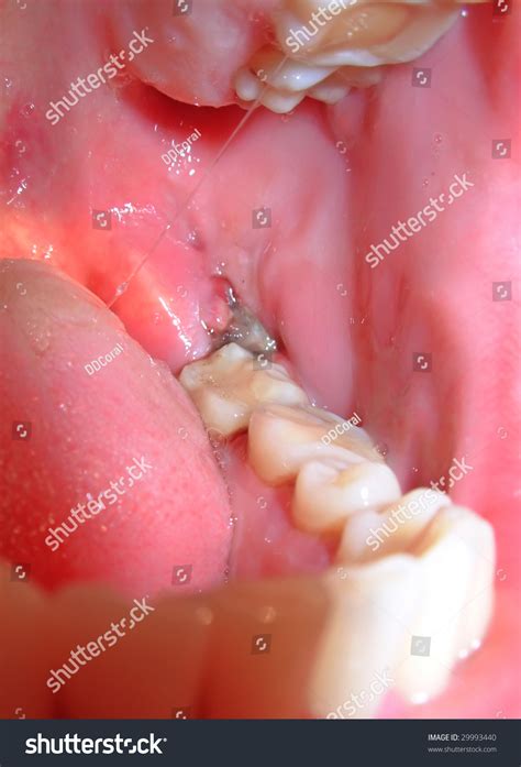 Clot Of Blood After Extraction Of A Wisdom Tooth Stock Photo 29993440