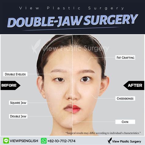 Complete Transformation At View Plastic Surgery Double Jaw Surgery