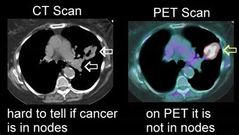 Cancer Lymph Nodes Ct Scan Ct Scan Machine