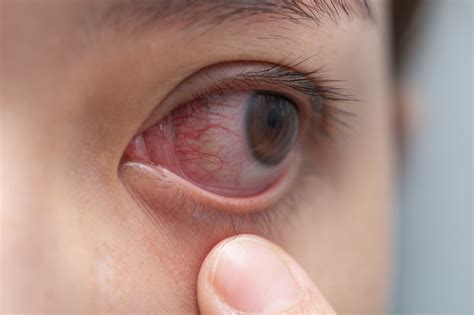 Herpes Eye Infections Prevention And Treatment Atlantic Eye Institute