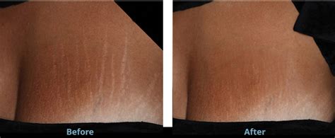 Stretch Mark Laser Removal Before And After Results Real Cases